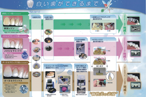 クラウン（差し歯・被せ物）PDF